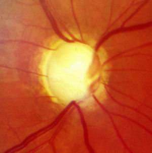 глаукома на один глаз